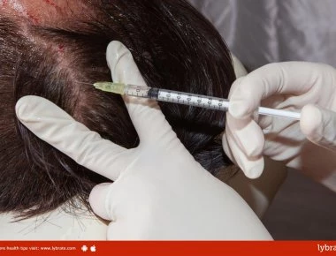 Πάνω από 1 δισ.€ τα οφέλη της τουρκικής οικονομίας από τις… μεταμοσχεύσεις μαλλιών!